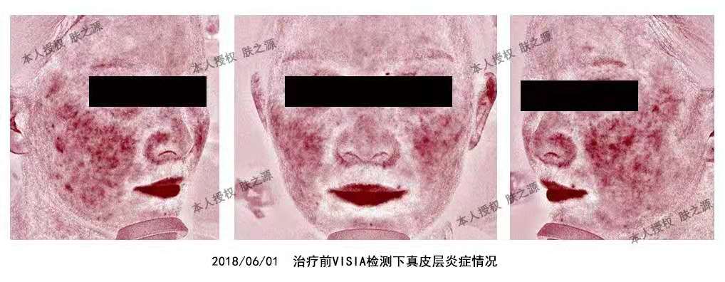 患者分享|我的药物依赖合并玫瑰痤疮的治疗经历